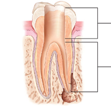 Root Canal In Ingle Farm: Benefits