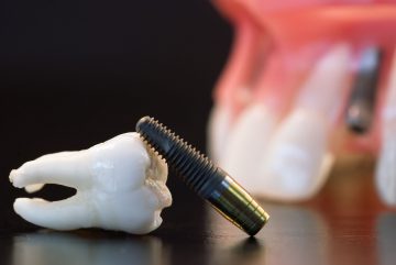 Dental Implants: Why Consider Them