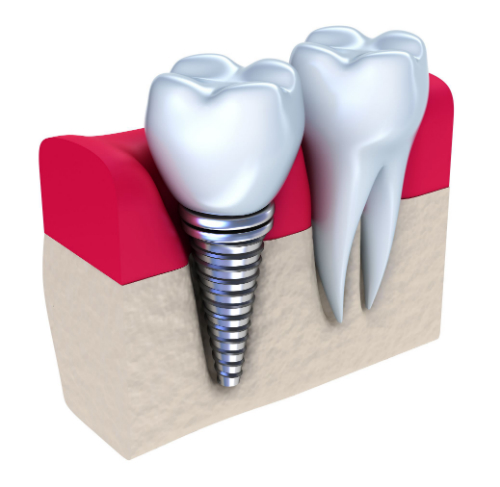 Dental Implants In Castle Hill: Benefits